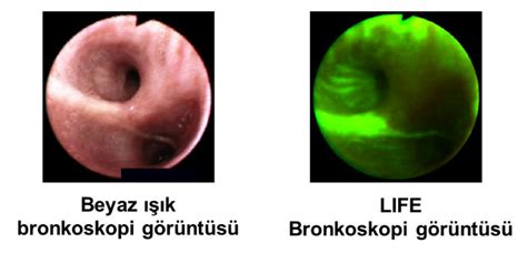 Bronkoskopi Prof Dr Adalet Demir