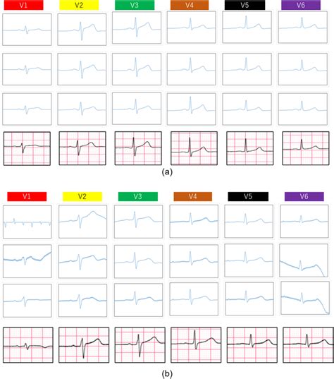 The 18-lead ECG signals measured by the wearable multi-lead ECG ...