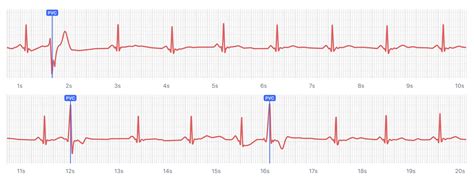 What Heart Palpitations and Irregular Heartbeats Look Like on Your ...