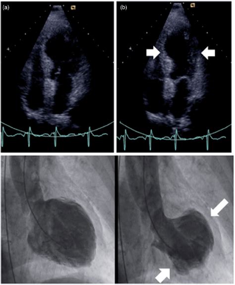 Echocardiographic 4 Chamber View Showing Tts Midventricular Type On The