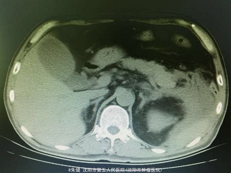 急性胰腺炎一例 医联