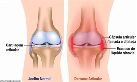 Cisto de Baker água no joelho derrame articular inchaço o que pode