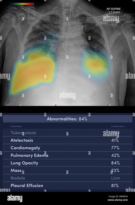 Radiographie Thoracique Asthme Banque De Photographies Et Dimages