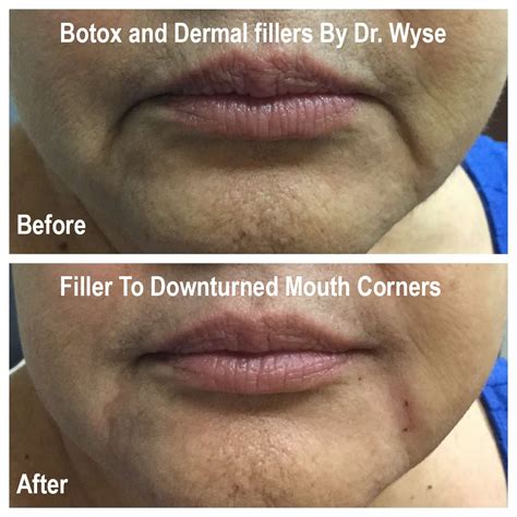 Botox For Downturned Lips Lipstutorial Org