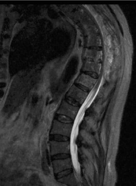 T 2 Weighted Sagittal MRI Of The Thoracolumbar Spine Demonstrating