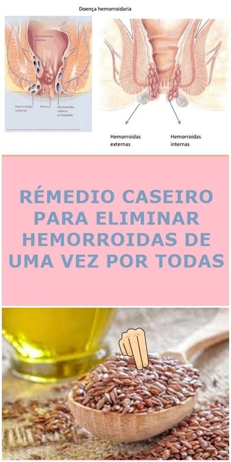 Remédios Caseiros Para Eliminar Hemorroidas Rapidamente Hemorróidas