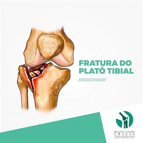 Fratura Do Plat Tibial Dr Luis Claudio Chagas Especialista Em Joelho