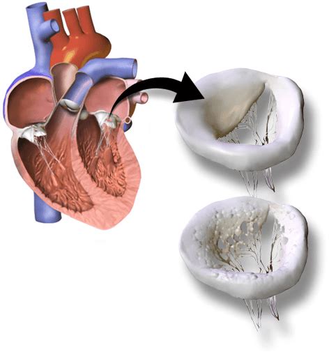 Learn How Heart Valve Replacement Works | Valiant Clinic