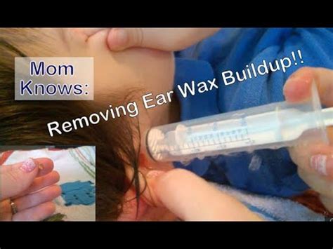 Removing Ear Wax Buildup At Home Flushing Out Ear Wax W Hydrogen