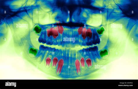 CHILD TOOTH, X-RAY Stock Photo - Alamy