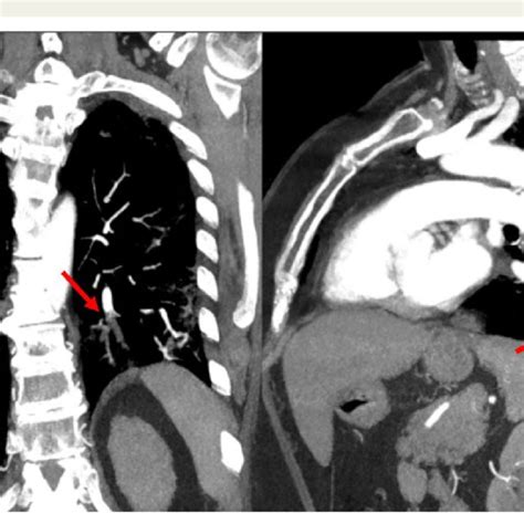 A Pulmonary Angiography Showing Acute Bilateral Pulmonary Embolism Red Download Scientific