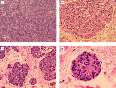 Uterine Smooth Muscle Tumours Practical Approach To Diagnosis