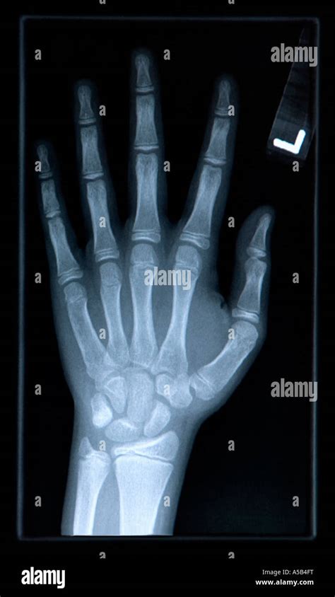 Close Up Of Xray Of Hand Stock Photo Alamy