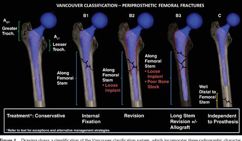 Periprosthetic Femoral Fractures In The Emergency Department What The Orthopedic Surgeon Wants