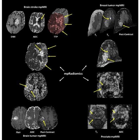 Illustration Of The Five Different Types Of Multiparametric Radiomics