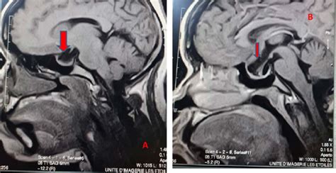 MRI In Sagittal T1 Sequence A Without Injection Of Gadolinium And