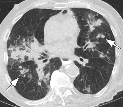 Spectrum Of Ct Findings In Thoracic Extranodal Non Hodgkin Lymphoma