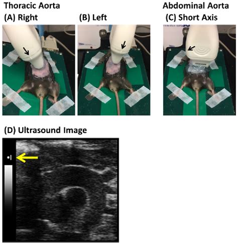 Figure 2 From Ultrasound Imaging Of The Thoracic And Abdominal Aorta In