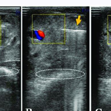 Color Flow Doppler Guided Pudendal Nerve Block A Identification Of