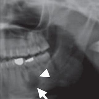 year-old woman with periapical cyst. Cropped panoramic radiograph shows ...