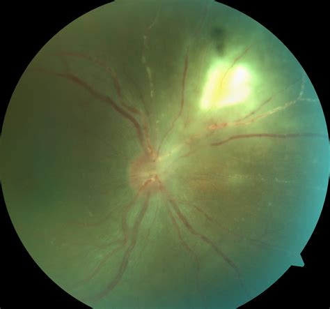 Toxoplasma retinochoroiditis – the retina vault