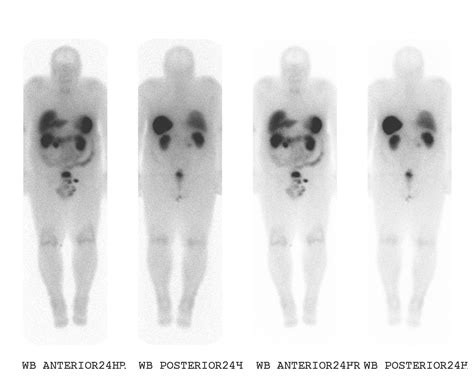 Neuroendocrine tumors other imaging findings - wikidoc