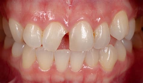 Chipped Tooth Causes And Treatment Methods