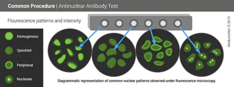 Antinuclear Antibody Ana Test Results And Causes Of Elevated Anas