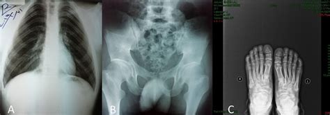 A Chest Radiograph Pa View Hypoplastic Clavicles And Narrow