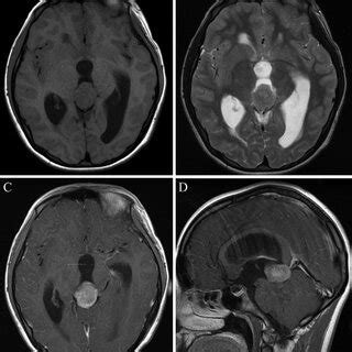 Preoperative T Weighted A And T Weighted B Mri Scans Show A Round