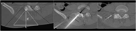 A Ct Scan Of An Oo Located In The Right Articular Process Of L5 Download Scientific Diagram