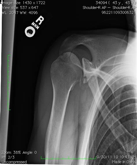 How Do You Treat a Shoulder Fracture? - Portland, Oregon Concierge ...