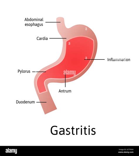 Gastritis Inflamación Irritación O Erosión Del Revestimiento Del