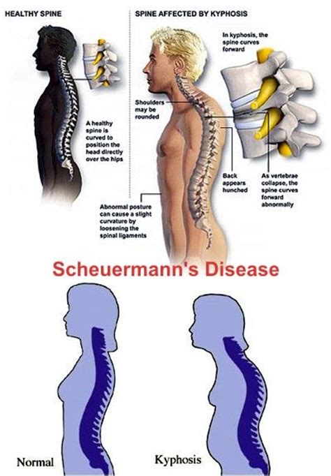 Scheuermann S Disease Definition Causes Symptoms Diagnosis And Treatment Hands Shoulder