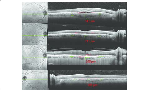 A Macular Subretinal Fluid On Oct With A Choroidal Thickness Of 341 μm