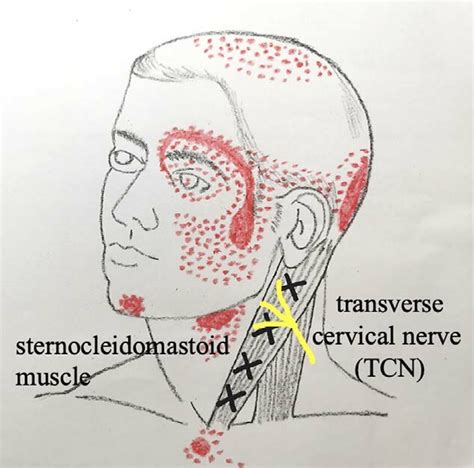 Referral Pattern Of The Trigger Point In The Sternocleidomastoid Muscle