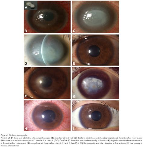 Risk Factors And Clinical Signs Of Severe Acanthamoeba Keratitis Opth