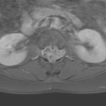 Spinal Schwannoma Image Radiopaedia Org