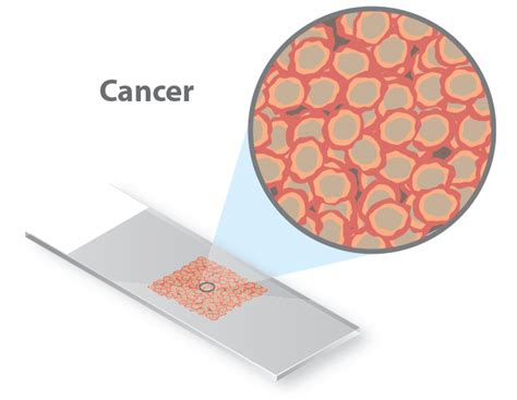 Microsatellite Instability Caris Life Sciences