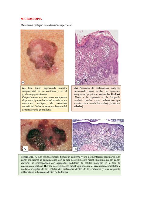 Melanoma Microscopia Microscopia Melanoma Maligno De Extensión