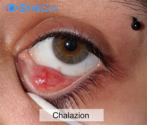 Chalazion Images