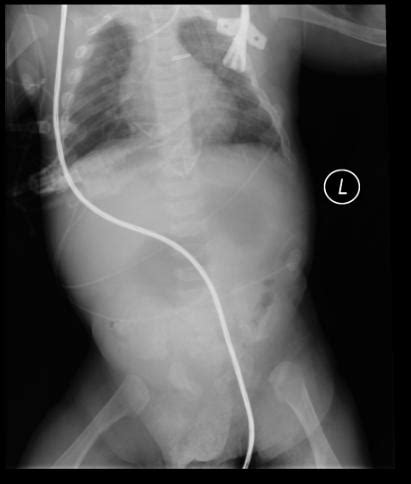 Pyloric stenosis other imaging findings - wikidoc