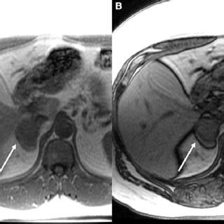 Axial chemical shift MRI demonstrates minimal reduction in signal from ...