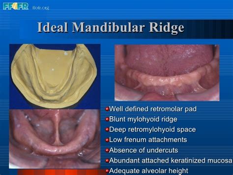 2anatomy Of The Denture Foundation Areas