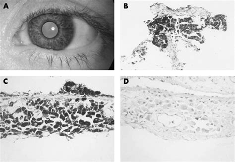 A Anterior Segment Photograph Of The Left Eye On Presentation In 1995