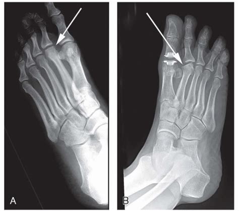 Metatarsalgia | Musculoskeletal Key