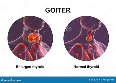 Enlarged Thyroid Gland 3d Illustration Stock Illustration Illustration Of Neck Disease