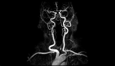 Magnetic Resonance Angiography | GWIC