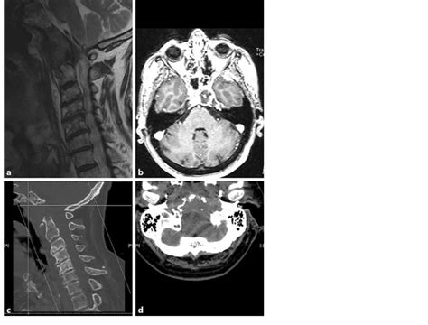 Preoperative Mri And Ct Scan A B Preoperative T2 Weighted Sagittal