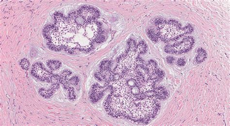 Ameloblastoma Histology